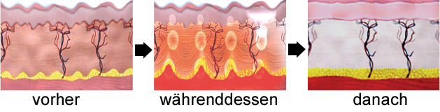 UF3 HyperthermischeLiftingtherapie